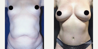 Case 1659 - Woman treated with Tummy Tuck