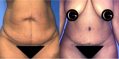 Case 166 - Woman treated with Tummy Tuck