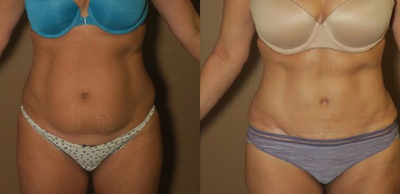 Case 1660 - Patient treated with Tummy Tuck