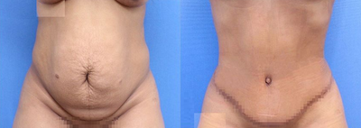 Case 1662 - Woman treated with Tummy Tuck