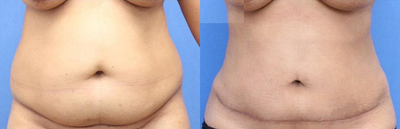 Case 1663 - Woman treated with Tummy Tuck