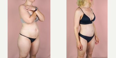 Case 1666 - 35-44 year old woman treated with Mommy Makeover, Tummy Tuck, Breast Augmentation, Liposuction, Breast Implants