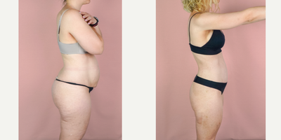 Case 1667 - 35-44 year old woman treated with Mommy Makeover, Tummy Tuck, Breast Augmentation, Liposuction, Breast Implants