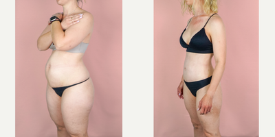 Case 1668 - 35-44 year old woman treated with Mommy Makeover, Tummy Tuck, Breast Augmentation, Liposuction, Breast Implants