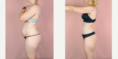 Case 1669 - 35-44 year old woman treated with Mommy Makeover, Tummy Tuck, Breast Augmentation, Liposuction, Breast Implants