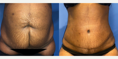 Case 167 - Woman treated with Tummy Tuck
