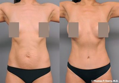 Case 1671 - 37 year old woman treated with Tummy Tuck