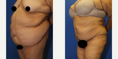 Case 1673 - 55-64 year old woman treated with Tummy Tuck