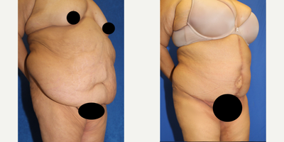 Case 1674 - 55-64 year old woman treated with Tummy Tuck