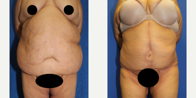 Case 1675 - 55-64 year old woman treated with Tummy Tuck