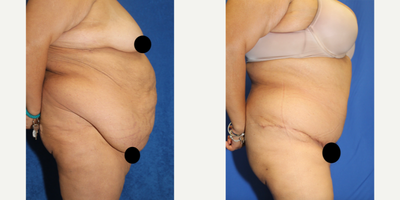 Case 1676 - 55-64 year old woman treated with Tummy Tuck