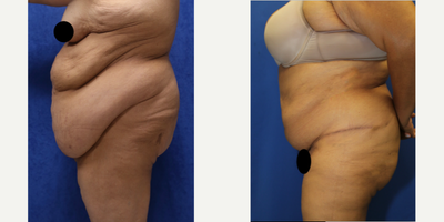 Case 1677 - 55-64 year old woman treated with Tummy Tuck