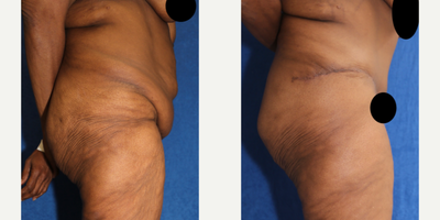 Case 1678 - 55-64 year old woman treated with Tummy Tuck