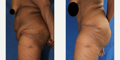 Case 1679 - 55-64 year old woman treated with Tummy Tuck