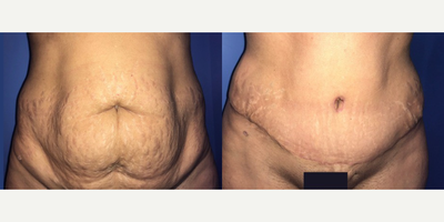 Case 168 - Woman treated with Tummy Tuck