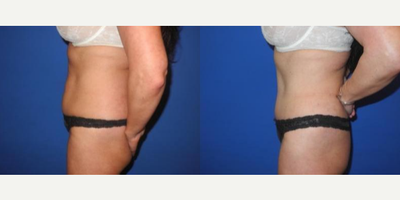 Case 1684 - 35-44 year old woman treated with Tummy Tuck