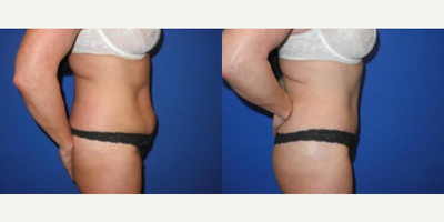 Case 1685 - 35-44 year old woman treated with Tummy Tuck