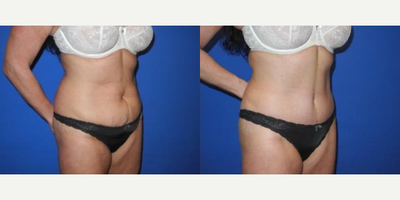 Case 1686 - 35-44 year old woman treated with Tummy Tuck