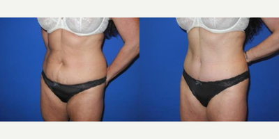 Case 1687 - 35-44 year old woman treated with Tummy Tuck