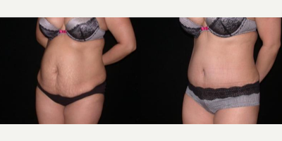 Case 1688 - Woman treated with Tummy Tuck