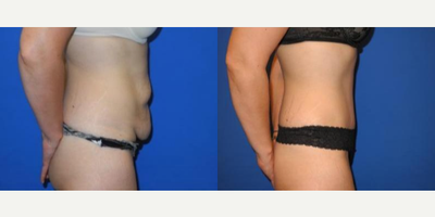 Case 1689 - Woman treated with Tummy Tuck