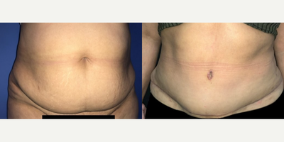 Case 169 - Woman treated with Tummy Tuck