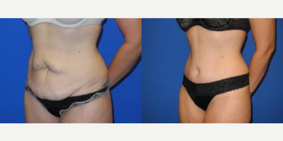 Case 1690 - Woman treated with Tummy Tuck