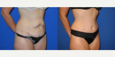 Case 1691 - Woman treated with Tummy Tuck