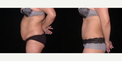 Case 1692 - Woman treated with Tummy Tuck