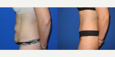 Case 1693 - Woman treated with Tummy Tuck