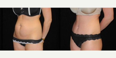 Case 1694 - Woman treated with Tummy Tuck