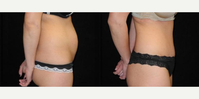 Case 1695 - Woman treated with Tummy Tuck