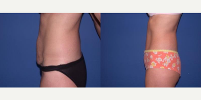 Case 1696 - Woman treated with Tummy Tuck