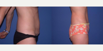 Case 1697 - Woman treated with Tummy Tuck