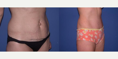 Case 1698 - Woman treated with Tummy Tuck