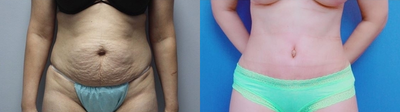 Case 1699 - Tummy Tuck