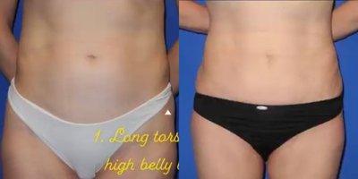 Case 17 - Woman treated with Tummy Tuck