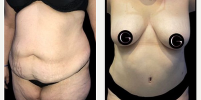 Case 170 - Woman treated with Tummy Tuck