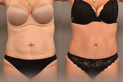 Case 1701 - Woman treated with Tummy Tuck