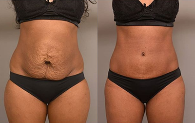 Case 1702 - Woman treated with Tummy Tuck