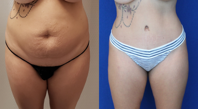 Case 1703 - 35-44 year old woman treated with Tummy Tuck