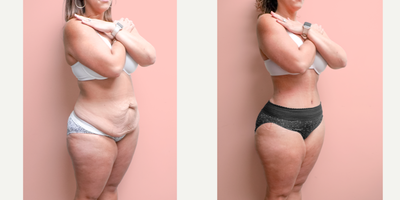 Case 1704 - 35-44 year old woman treated with Liposuction, Tummy Tuck