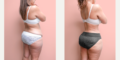 Case 1705 - 35-44 year old woman treated with Liposuction, Tummy Tuck