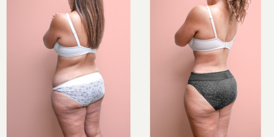 Case 1706 - 35-44 year old woman treated with Liposuction, Tummy Tuck