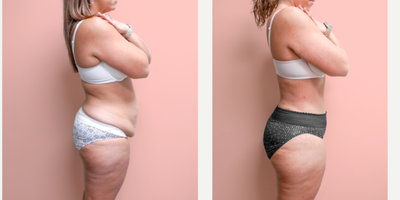 Case 1707 - 35-44 year old woman treated with Liposuction, Tummy Tuck