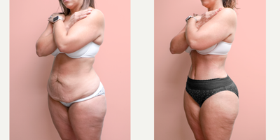 Case 1708 - 35-44 year old woman treated with Liposuction, Tummy Tuck