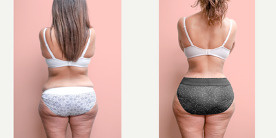 Case 1709 - 35-44 year old woman treated with Liposuction, Tummy Tuck