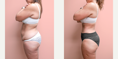 Case 1710 - 35-44 year old woman treated with Liposuction, Tummy Tuck