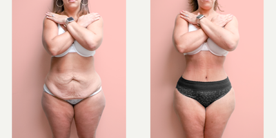 Case 1711 - 35-44 year old woman treated with Liposuction, Tummy Tuck