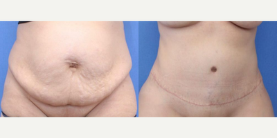 Case 1714 - Woman treated with Tummy Tuck